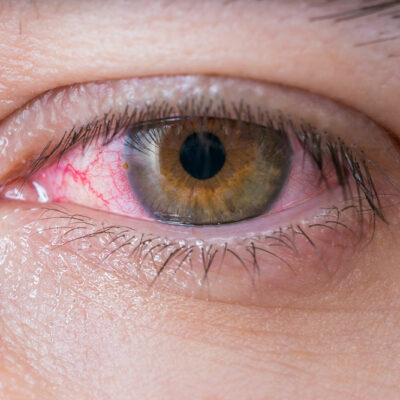 Red Eyes – Common Symptoms, Causes, and Treatment