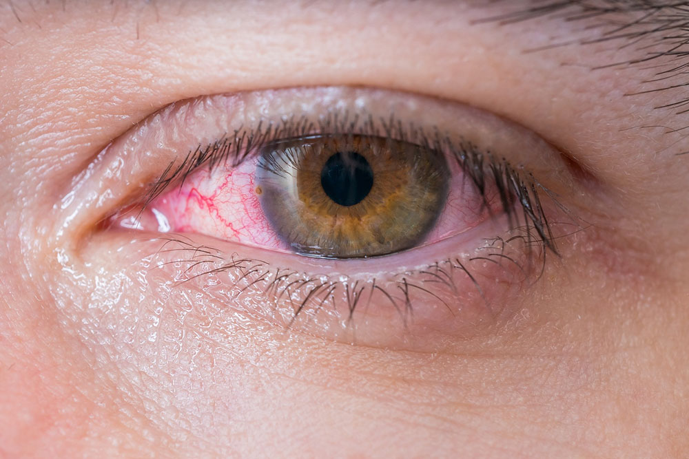 Red Eyes – Common Symptoms, Causes, and Treatment